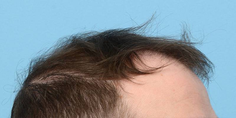 Fue Before and After | Dr. Jeffrey Wise