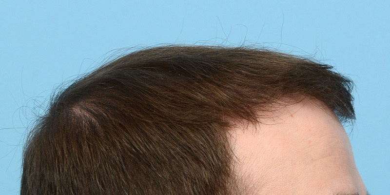 Fue Before and After | Dr. Jeffrey Wise