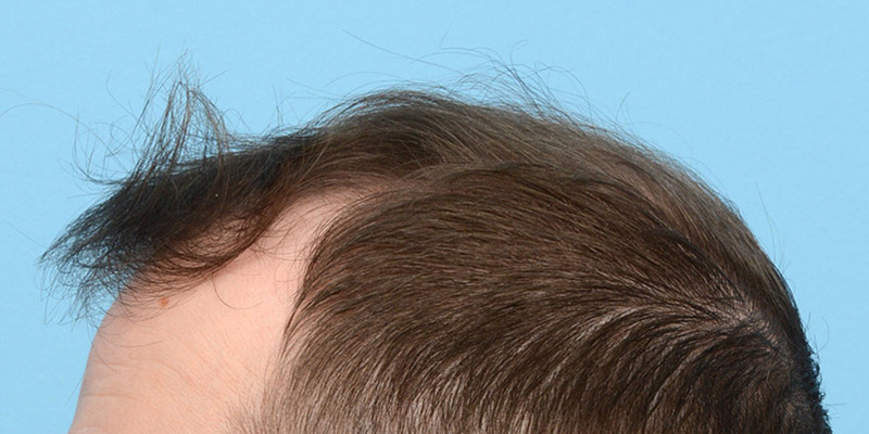 Fue Before and After | Dr. Jeffrey Wise