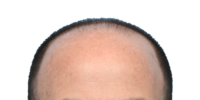 Fue Before and After | Dr. Jeffrey Wise