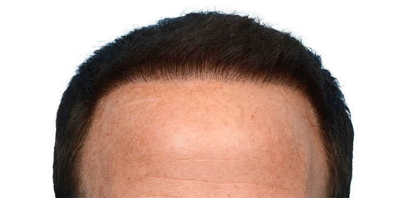 Fue Before and After | Dr. Jeffrey Wise