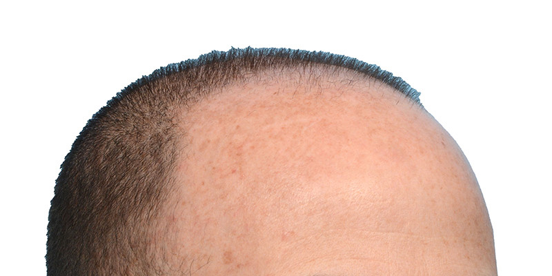 Fue Before and After | Dr. Jeffrey Wise