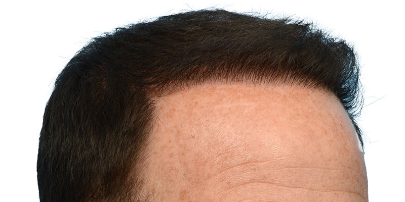 Fue Before and After | Dr. Jeffrey Wise