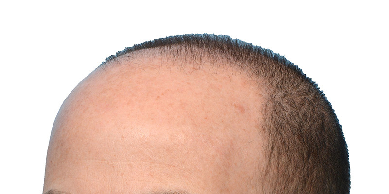 Fue Before and After | Dr. Jeffrey Wise