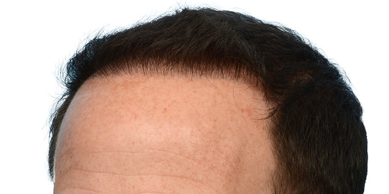 Fue Before and After | Dr. Jeffrey Wise