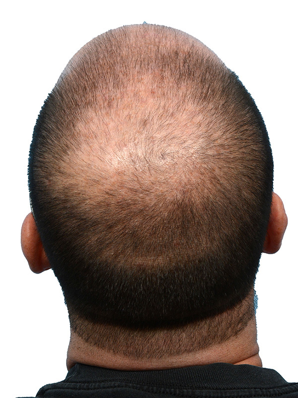 Fue Before and After | Dr. Jeffrey Wise