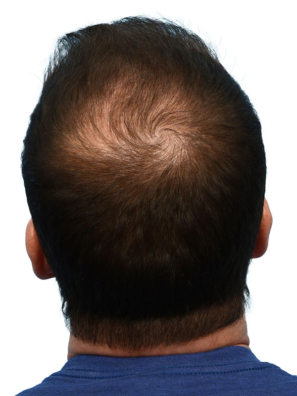 Fue Before and After | Dr. Jeffrey Wise