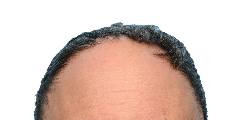 Fue Before and After | Dr. Jeffrey Wise