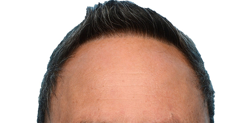 Fue Before and After | Dr. Jeffrey Wise