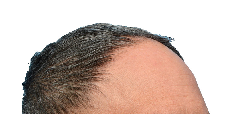 Fue Before and After | Dr. Jeffrey Wise