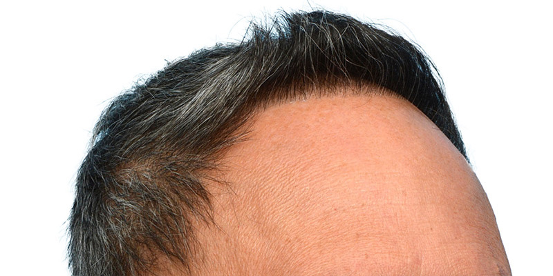 Fue Before and After | Dr. Jeffrey Wise