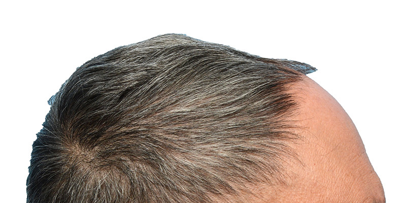 Fue Before and After | Dr. Jeffrey Wise