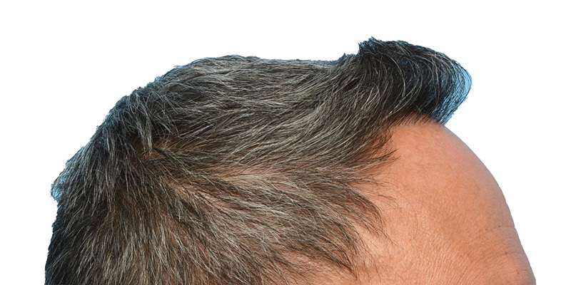 Fue Before and After | Dr. Jeffrey Wise