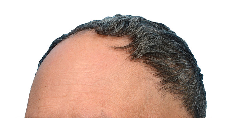 Fue Before and After | Dr. Jeffrey Wise