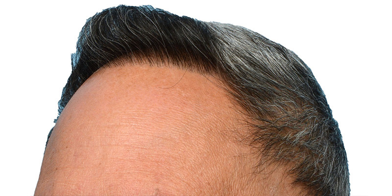 Fue Before and After | Dr. Jeffrey Wise