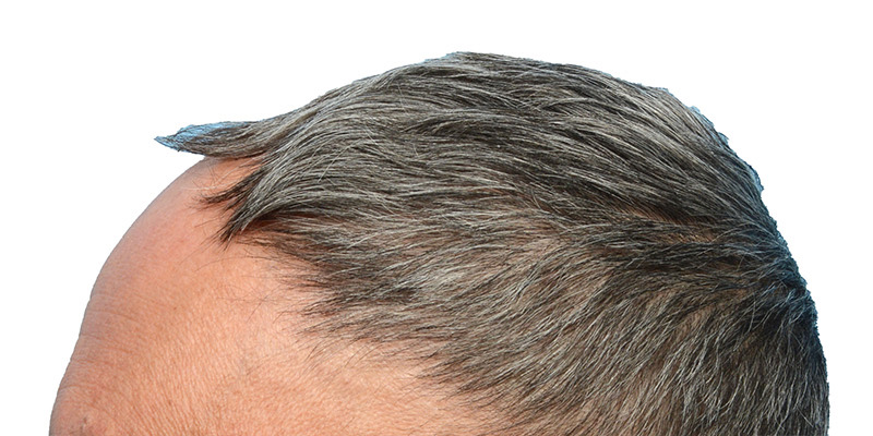 Fue Before and After | Dr. Jeffrey Wise