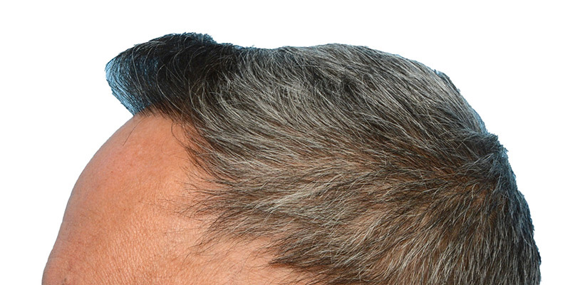 Fue Before and After | Dr. Jeffrey Wise