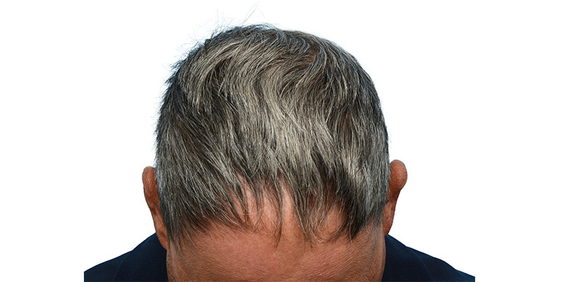 Fue Before and After | Dr. Jeffrey Wise