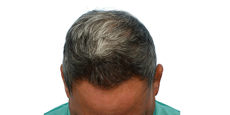 Fue Before and After | Dr. Jeffrey Wise