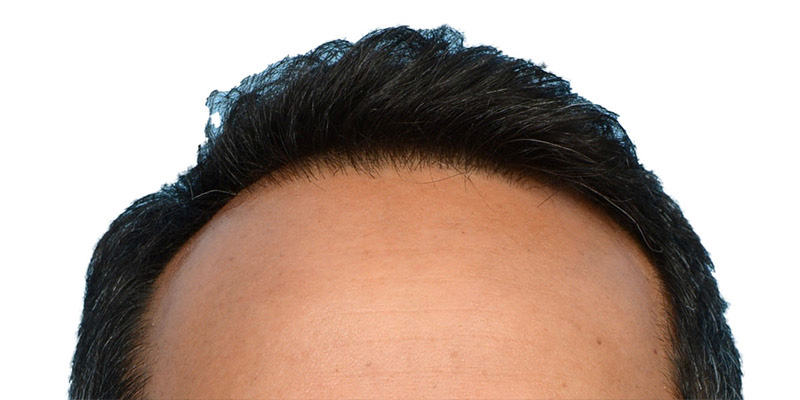 Fue Before and After | Dr. Jeffrey Wise