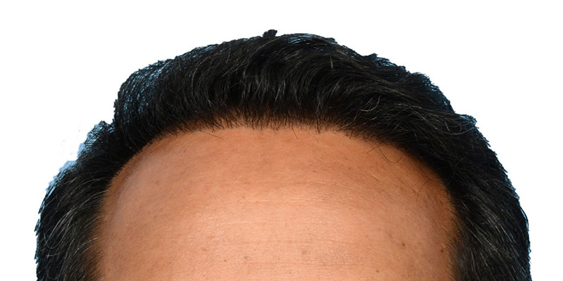 Fue Before and After | Dr. Jeffrey Wise