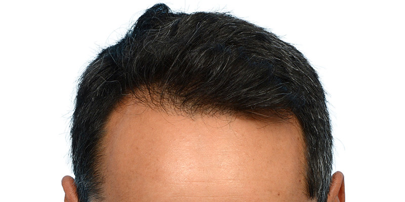 Fue Before and After | Dr. Jeffrey Wise