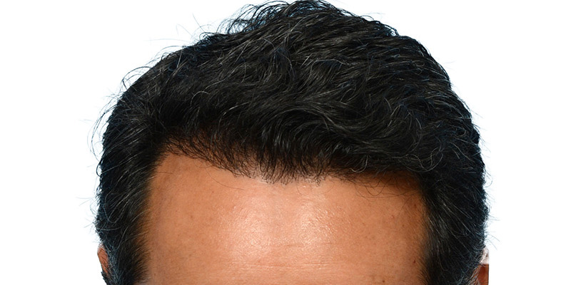 Fue Before and After | Dr. Jeffrey Wise