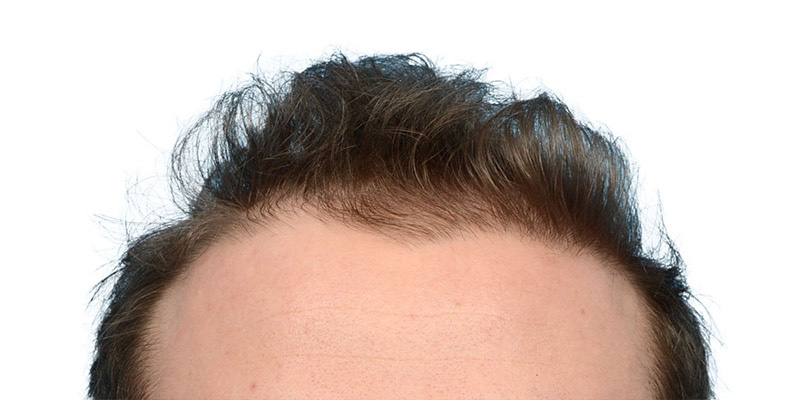 Fue Before and After | Dr. Jeffrey Wise