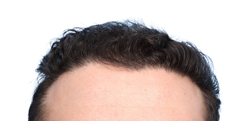 Fue Before and After | Dr. Jeffrey Wise