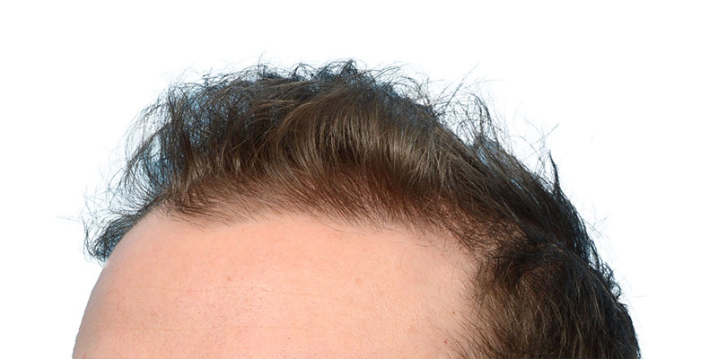 Fue Before and After | Dr. Jeffrey Wise