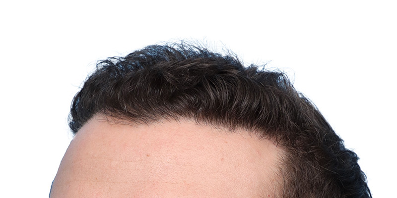 Fue Before and After | Dr. Jeffrey Wise