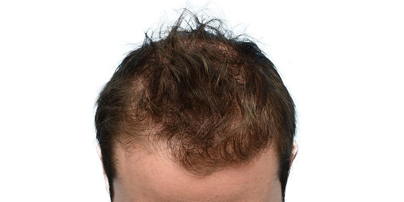 Fue Before and After | Dr. Jeffrey Wise