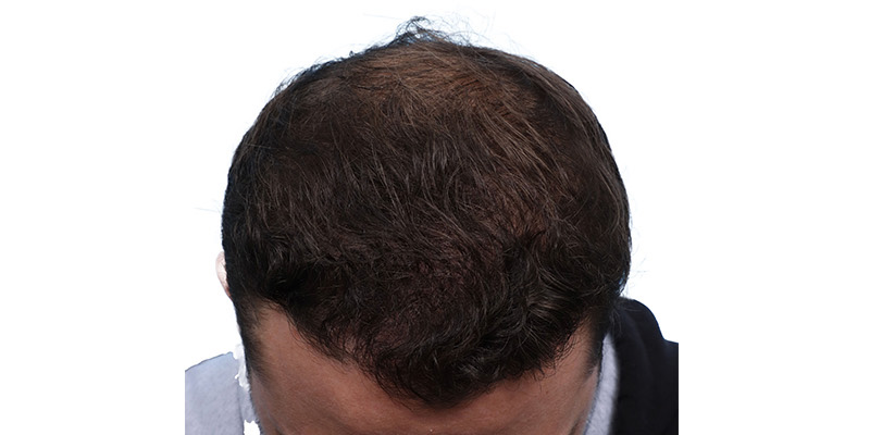 Fue Before and After | Dr. Jeffrey Wise