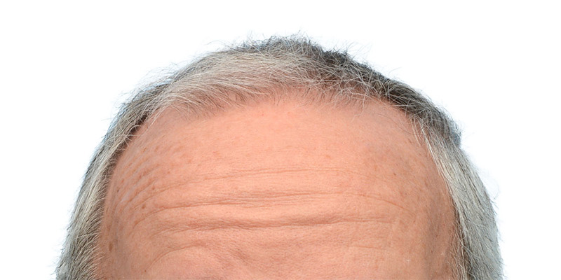 Fue Before and After | Dr. Jeffrey Wise