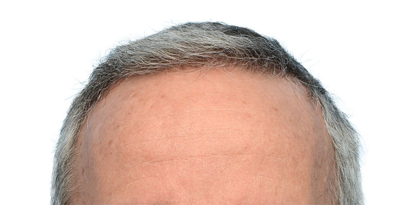 Fue Before and After | Dr. Jeffrey Wise