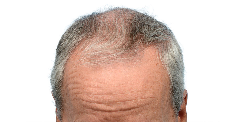 Fue Before and After | Dr. Jeffrey Wise