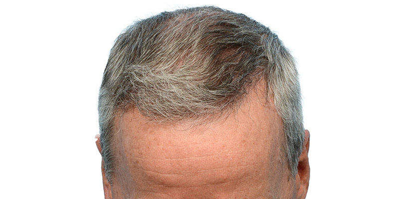 Witness Remarkable Hair Transplant Results: Before and After