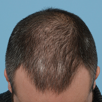 Fue Before and After | Dr. Jeffrey Wise