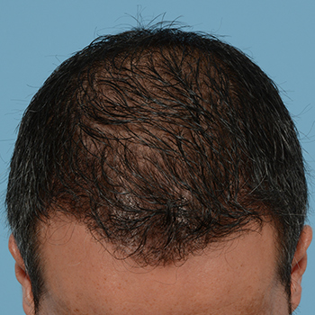 Fue Before and After | Dr. Jeffrey Wise