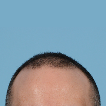 Fue Before and After | Dr. Jeffrey Wise