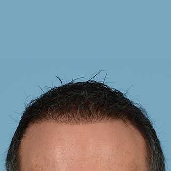 Fue Before and After | Dr. Jeffrey Wise