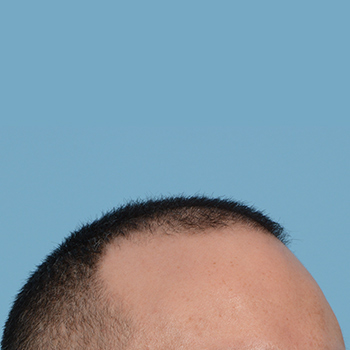 Fue Before and After | Dr. Jeffrey Wise