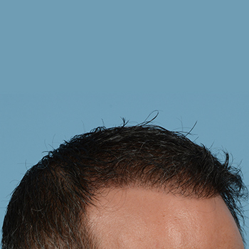 Fue Before and After | Dr. Jeffrey Wise