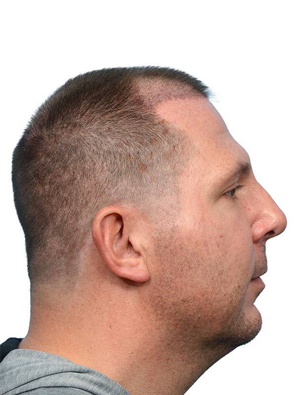 Fue Before and After | Dr. Jeffrey Wise