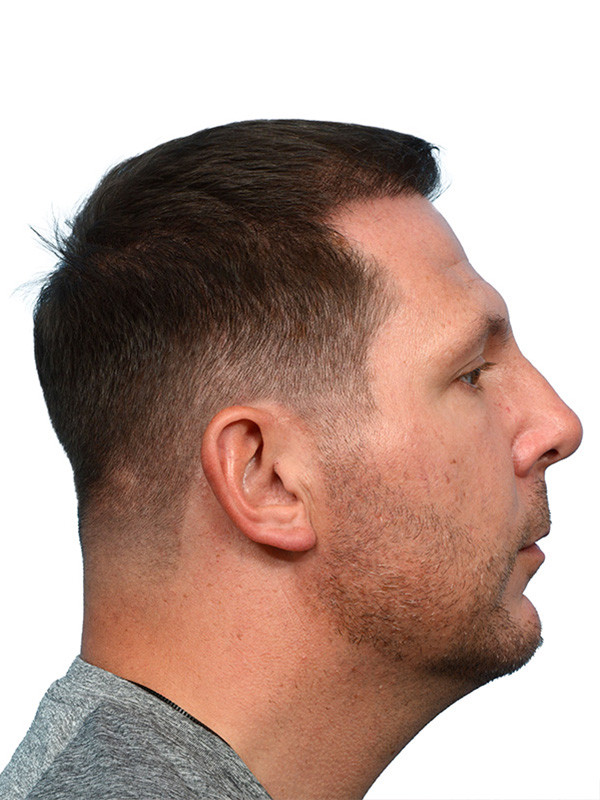 Fue Before and After | Dr. Jeffrey Wise