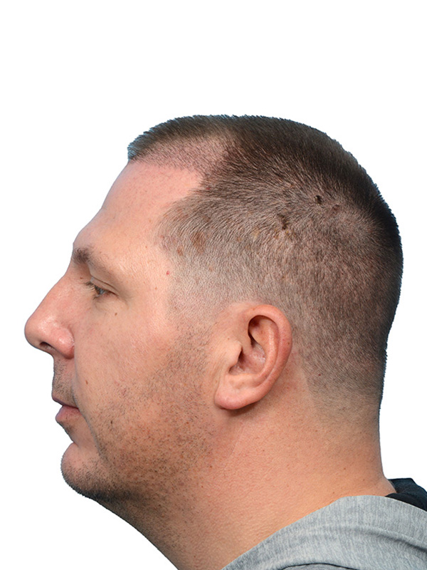 Fue Before and After | Dr. Jeffrey Wise