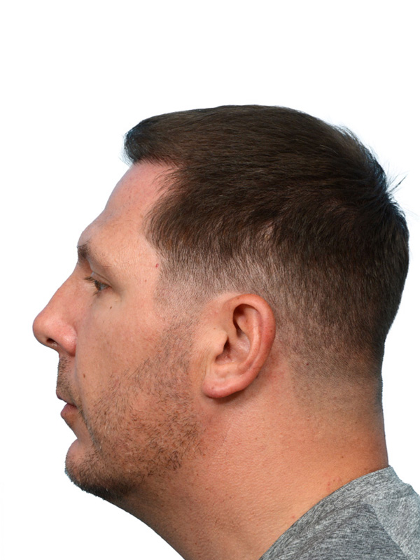 Fue Before and After | Dr. Jeffrey Wise