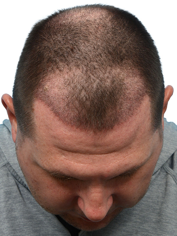 Fue Before and After | Dr. Jeffrey Wise