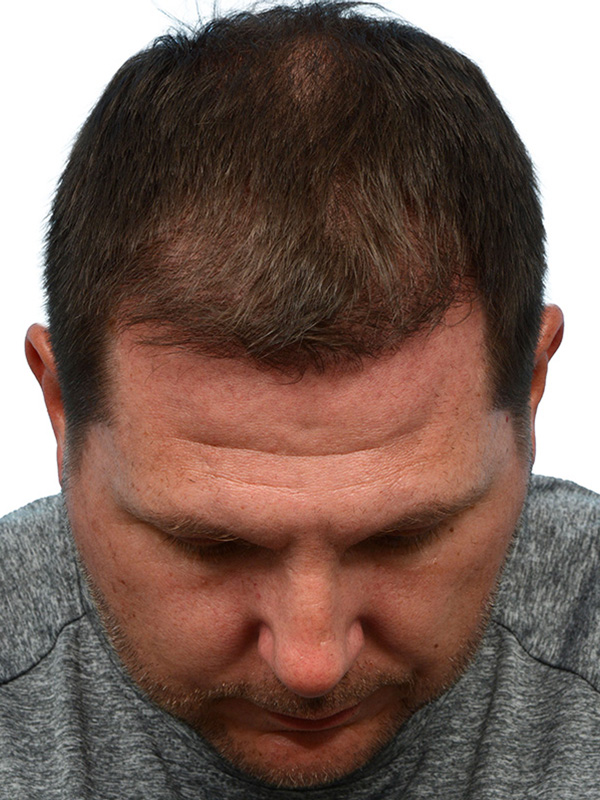 Fue Before and After | Dr. Jeffrey Wise