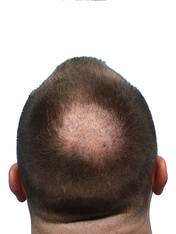 Fue Before and After | Dr. Jeffrey Wise